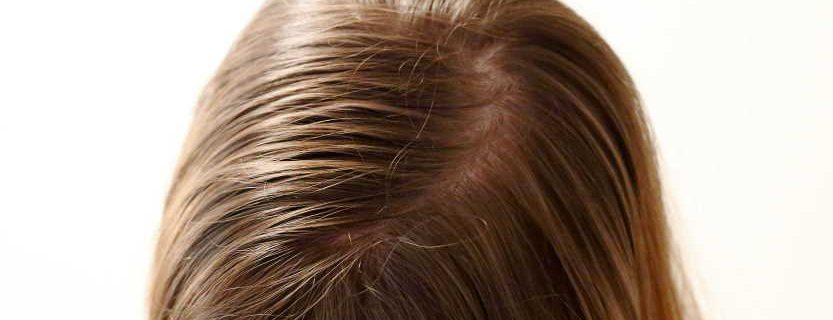 Home remedies for greasy hair
